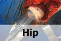 VJ Ortho orthopaedic surgery educational video - hip